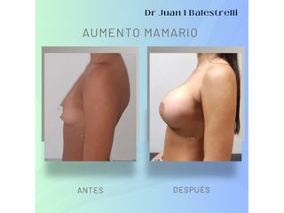 Aumento Mamario - Dr. Juan Ignacio Balestrelli