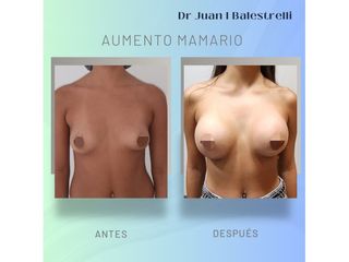 Aumento Mamario - Dr. Juan Ignacio Balestrelli