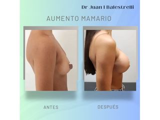 Aumento Mamario - Dr. Juan Ignacio Balestrelli
