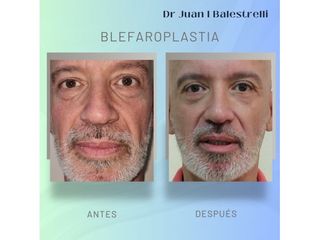 Blefaroplastia - Dr. Juan Ignacio Balestrelli