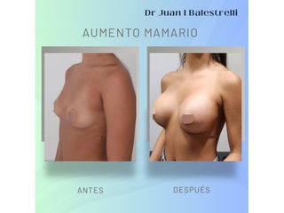 Aumento Mamario - Dr. Juan Ignacio Balestrelli