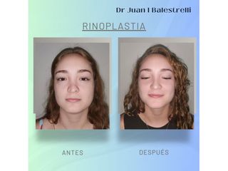 Rinoplastia - Dr. Juan Ignacio Balestrelli