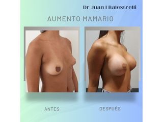 Aumento Mamario - Dr. Juan Ignacio Balestrelli