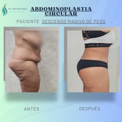 Abdominoplastia - Dr. Juan Ignacio Balestrelli