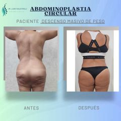 Abdominoplastia - Dr. Juan Ignacio Balestrelli