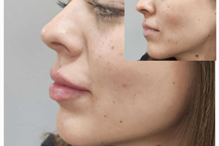 Relleno de labios antes y después - 863415