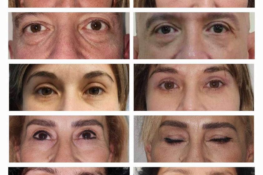 Blefaroplastia antes y después - 863416