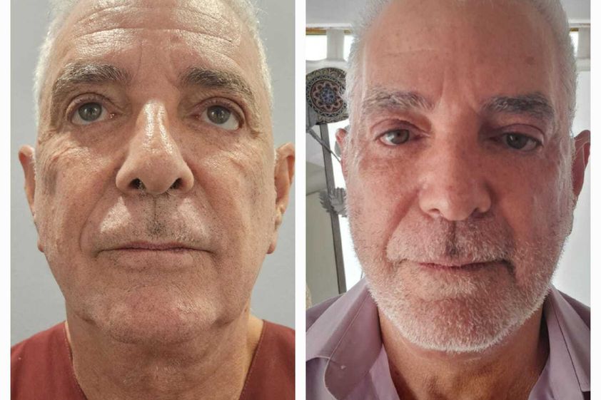 Lifting antes y después - 863418