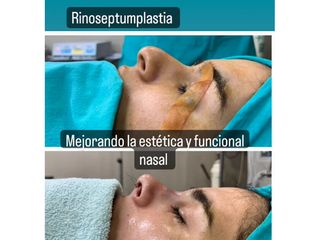 Rinoplastia - Dr. Juan Ignacio Balestrelli