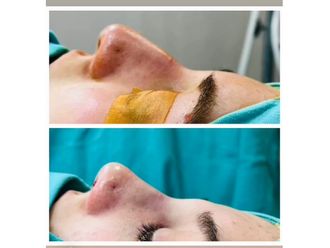 Rinoplastia antes y después - 880752