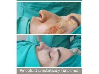 Rinoplastia antes y después - 880753