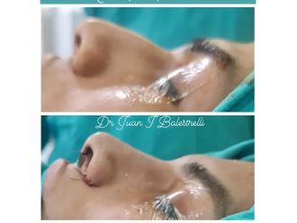 Rinoplastia antes y después - 880754