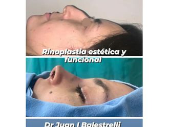 Rinoplastia antes y después - 880755