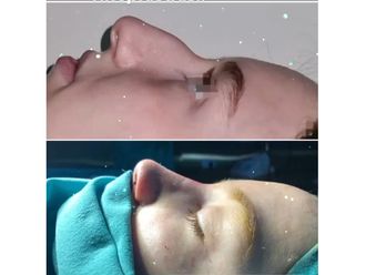 Rinoplastia antes y después - 880756