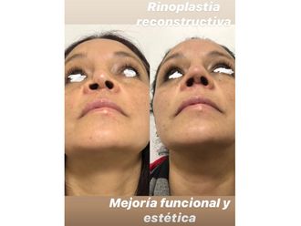 Rinoplastia antes y después - 880757