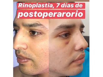 Rinoplastia antes y después - 880758