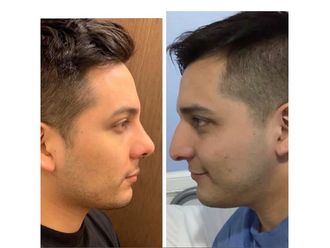 Rinoplastia antes y después - 880759