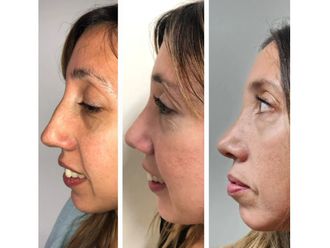 Rinoplastia antes y después - 880761