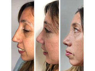 Rinoplastia - Dr. Juan Ignacio Balestrelli