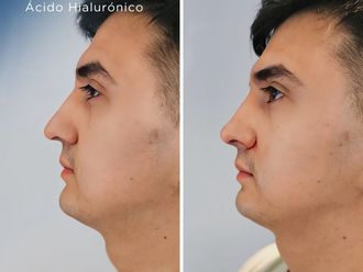 Rinomodelación antes y después - 880762