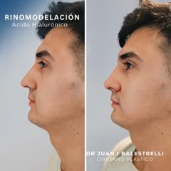 Rinomodelación - Dr. Juan Ignacio Balestrelli