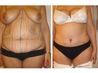 Abdominoplastía