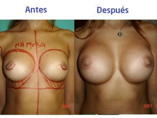 Cirugía de Mamas