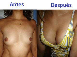 Cirugía de Mamas