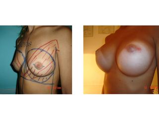 Aumento de mamas - Antes y Después