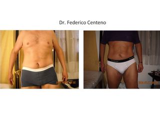 Abdominoplastia - Antes y Después