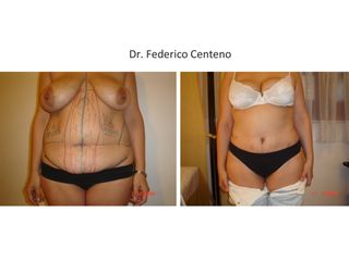 Abdominoplastia  - Antes y Después