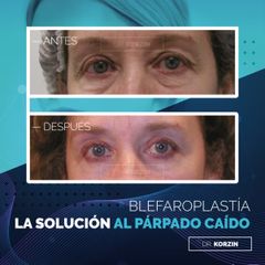 Blefaroplastia - Dr. Sergio Korzin