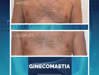 Ginecomastia - 797747