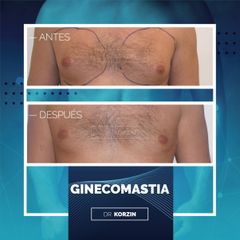 Ginecomastia - Dr. Sergio Korzin