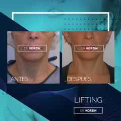 Lifting - Dr. Sergio Korzin