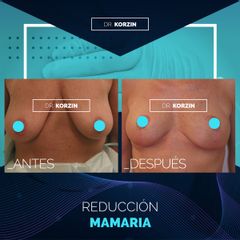 Reducción de mamas - Dr. Sergio Korzin