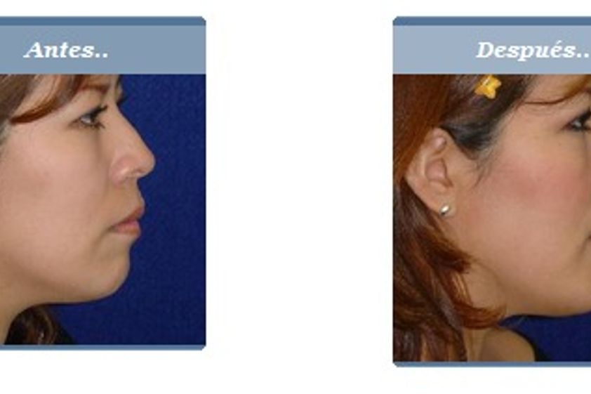 Mentoplastia antes y después - 280850
