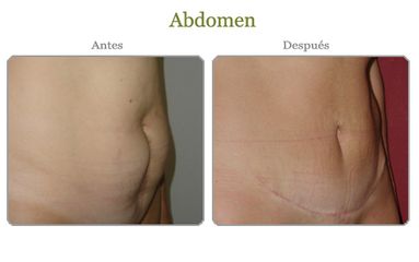 Abdomen