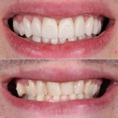 Carillas Dentales - AM Estética Dental