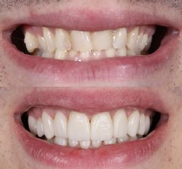 Carillas Dentales - AM Estética Dental