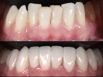 Carillas dentales antes y después - 880460