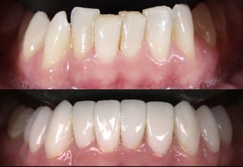 Carillas Dentales - AM Estética Dental