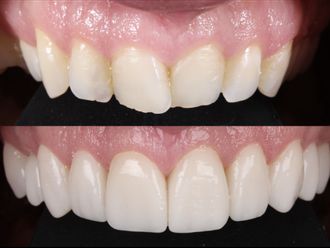 Carillas dentales antes y después - 880461