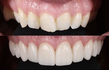 Carillas Dentales - AM Estética Dental