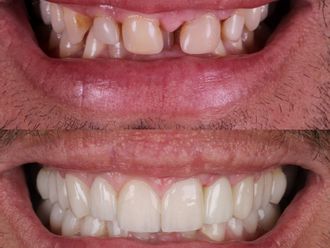 Carillas dentales antes y después - 880462