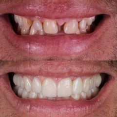 Carillas Dentales - AM Estética Dental