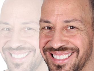 Carillas dentales antes y después - 880463