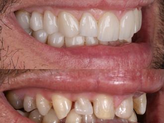 Carillas dentales antes y después - 880464
