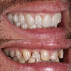 Carillas Dentales - AM Estética Dental