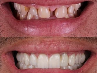 Carillas dentales antes y después - 880465